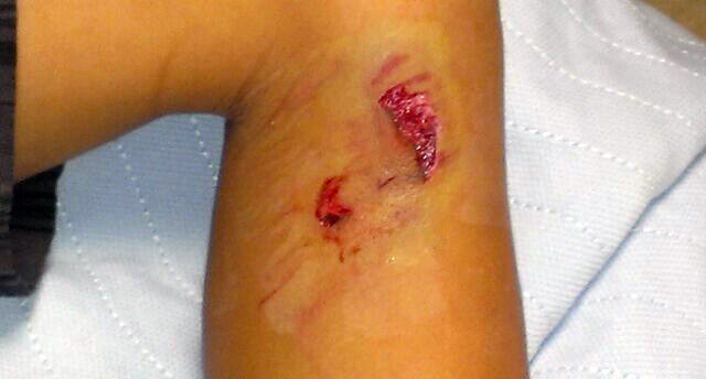 Dog Bite Injuries