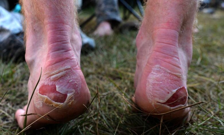 Cracked Heels